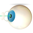 Bladeless Cataract Surgery