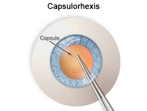 Singapore cataract surgery