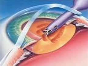 Cataract surgery in singapore