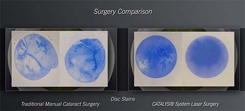 Bladeless cataract surgery