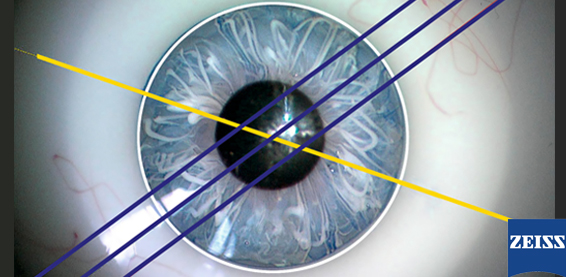 Bladeless cataract surgery