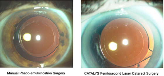 Bladeless laser cataract surgery