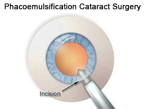 Cataract surgery singapore