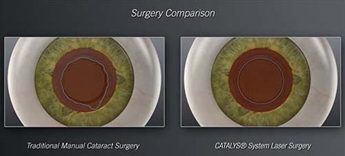 Singapore bladeless cataract surgery