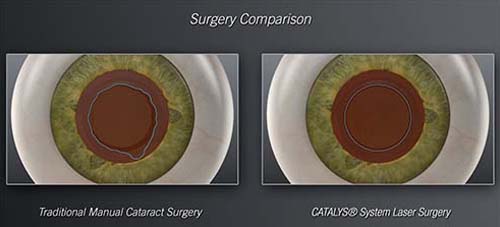 Singapore bladeless cataract surgery