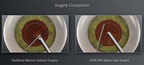 Bladeless cataract surgery in singapore