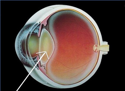 Eye with cataract