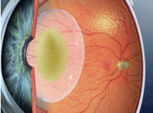 Eye with cloudy crystalline lens or cataract