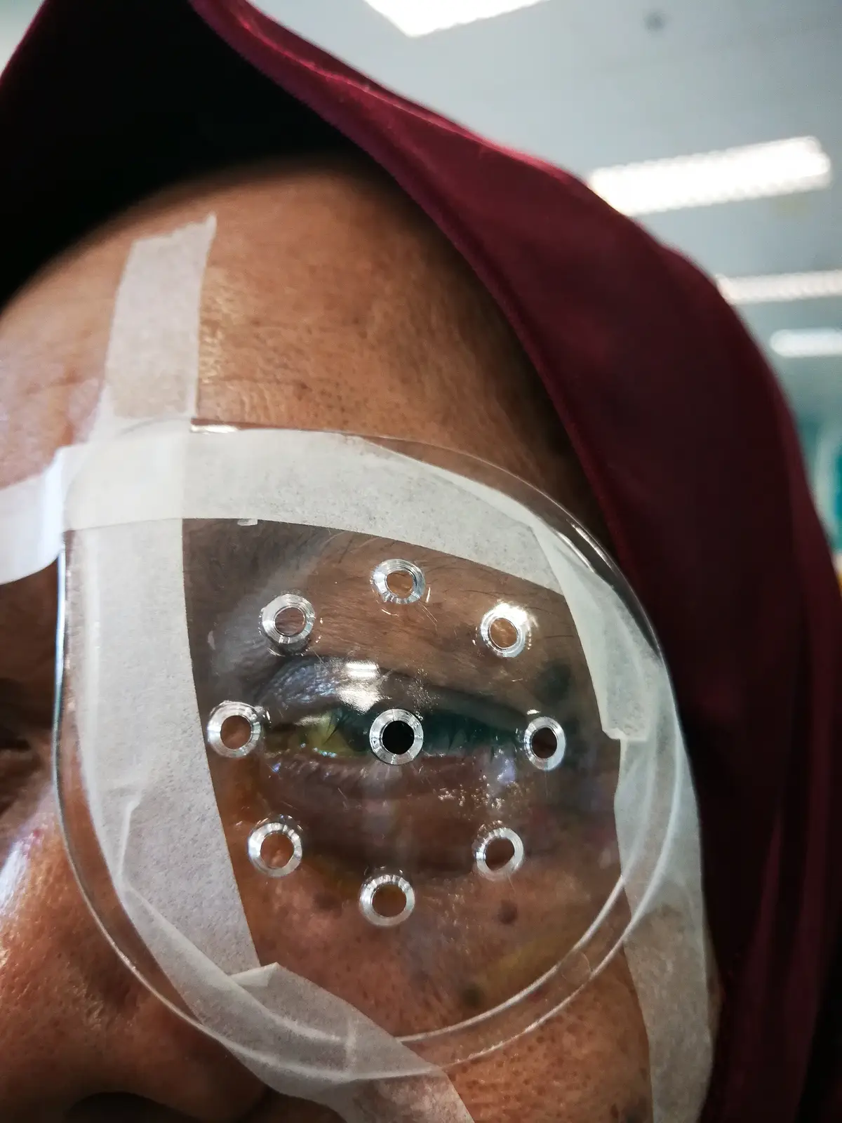 patient after cataract surgery