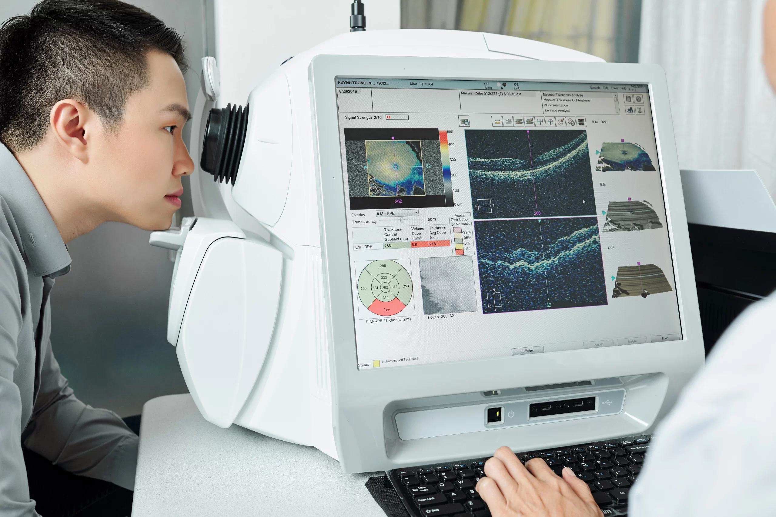 macular degeneration