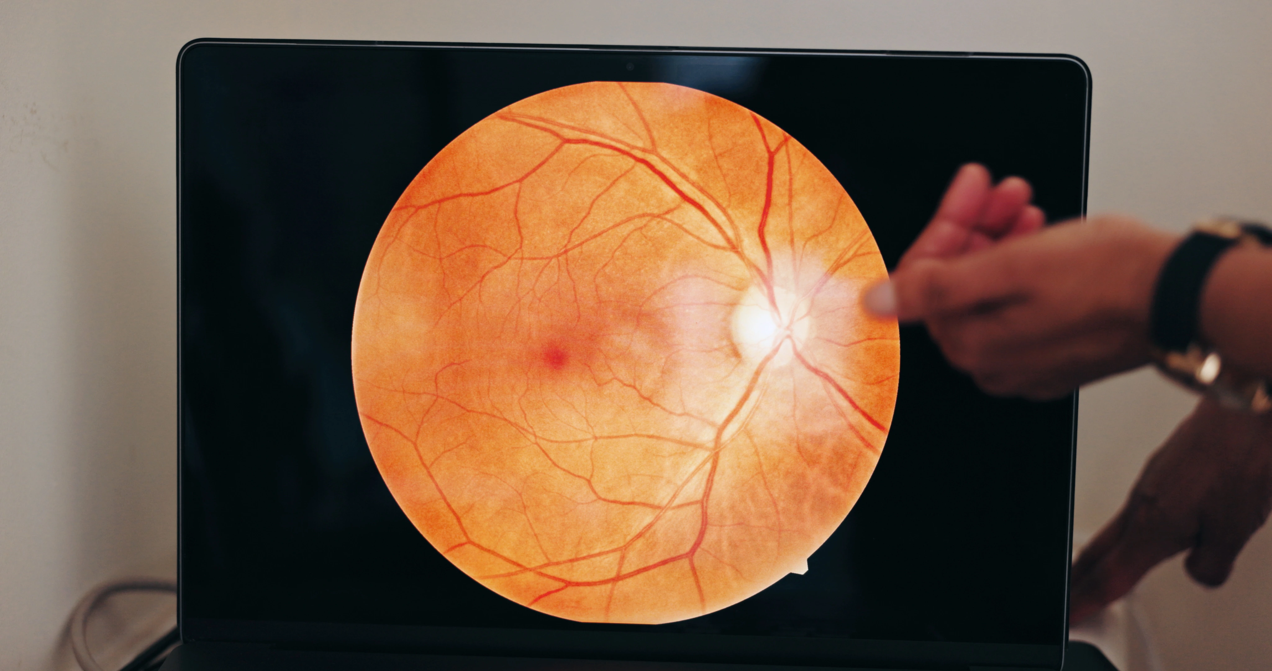 macular degeneration singapore