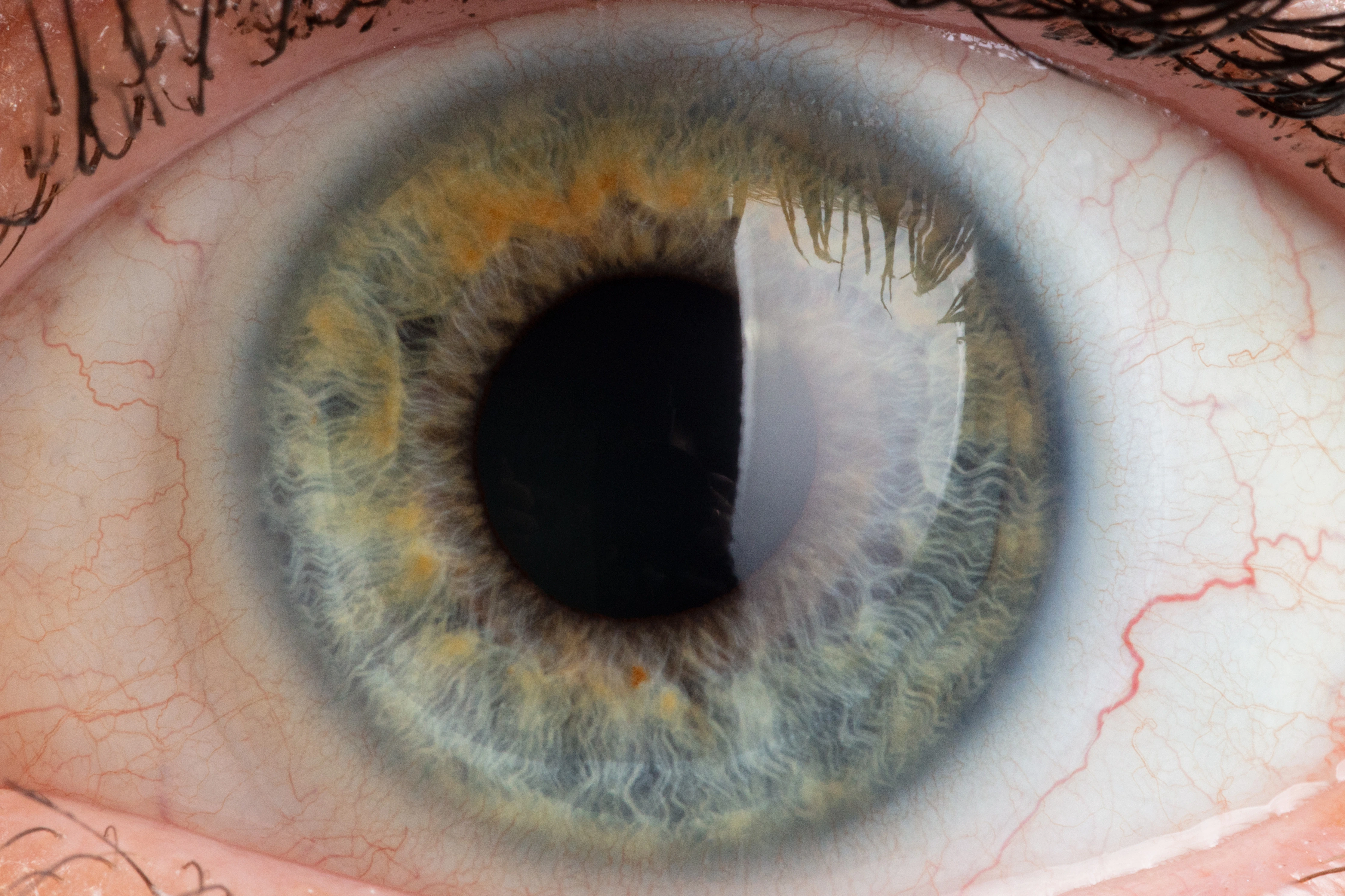 Glaucoma eye treatment